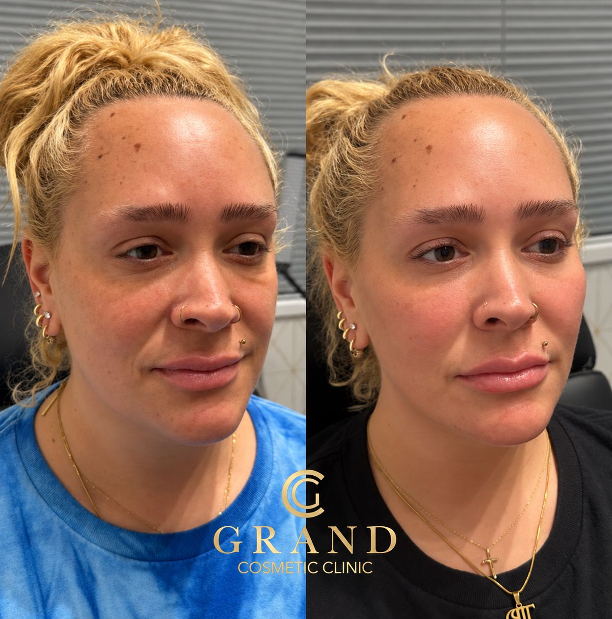 Before and after results at Grand Cosmetic Clinic