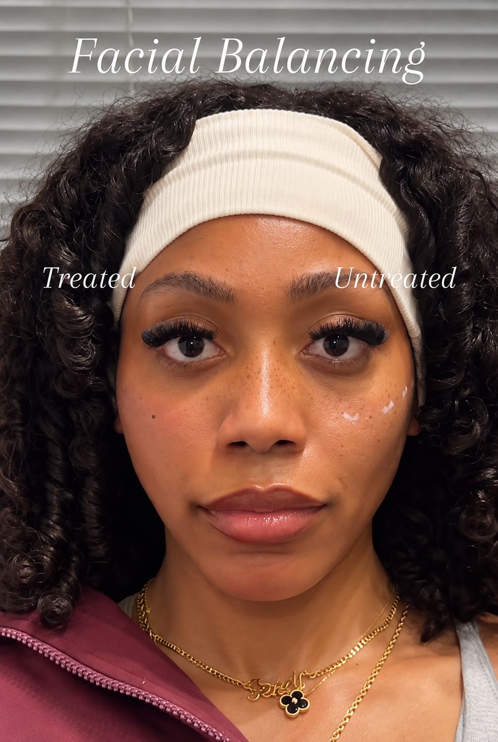 Facial balancing result: treated side compared with untreated side